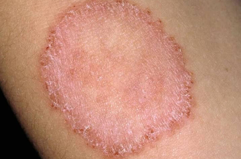 Fungal Infections 